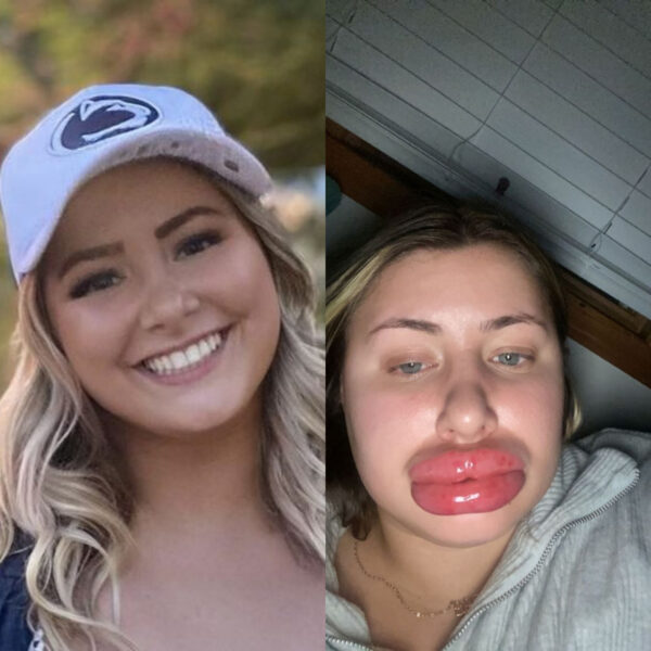 Woman’s lips swells to ‘eight times the normal size’ after allergic reaction to fillers